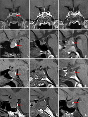 Pituitary stalk changes on magnetic resonance imaging following pituitary adenoma resection using a transsphenoidal approach